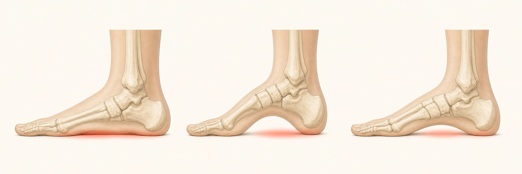 Seitliche Anatomie eines niedrigen, hohen und neutralen Fußgewölbes